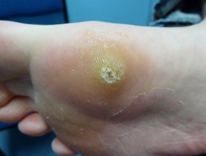 The plantar papillomas The plantar papillomas