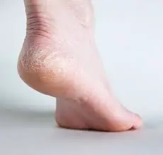 cracked skin of the feet